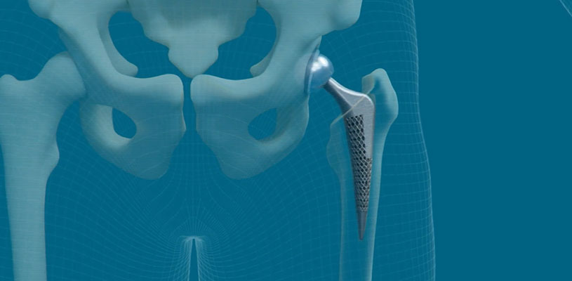 A 3D-printed solid-lattice hip prosthesis.